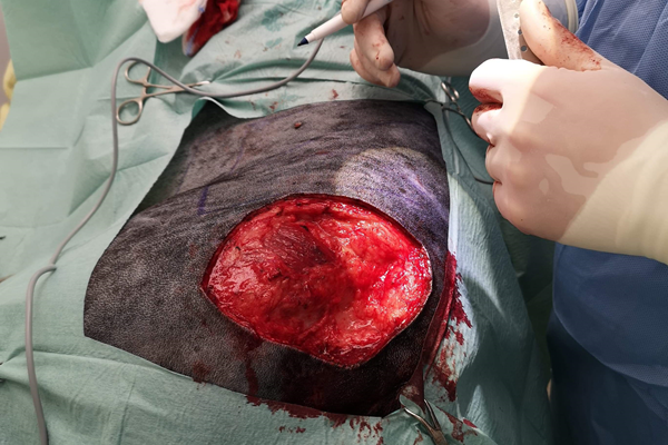 Ben Rice Start Of Surgery